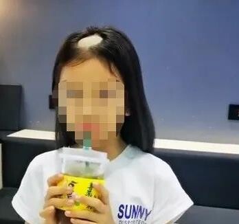 중국서 어린 소녀 돌연 탈모…알고보니 '고양이균' 때문