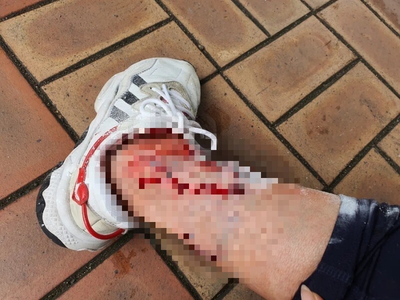 풀어놓은 대형견에 물려 발목신경 손상됐는데…견주 "보상 못해"