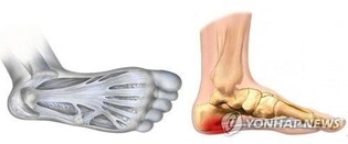 [위클리 건강] "타이거우즈도 절게 한 '족저근막염'…생활 속 원인 찾아야"